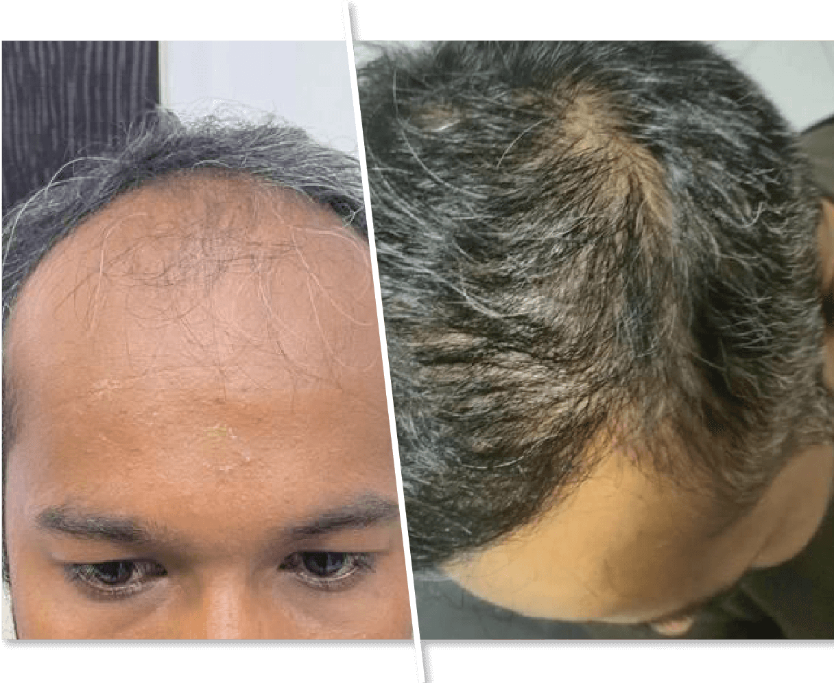 Men Hair Transplant Before and After Picture